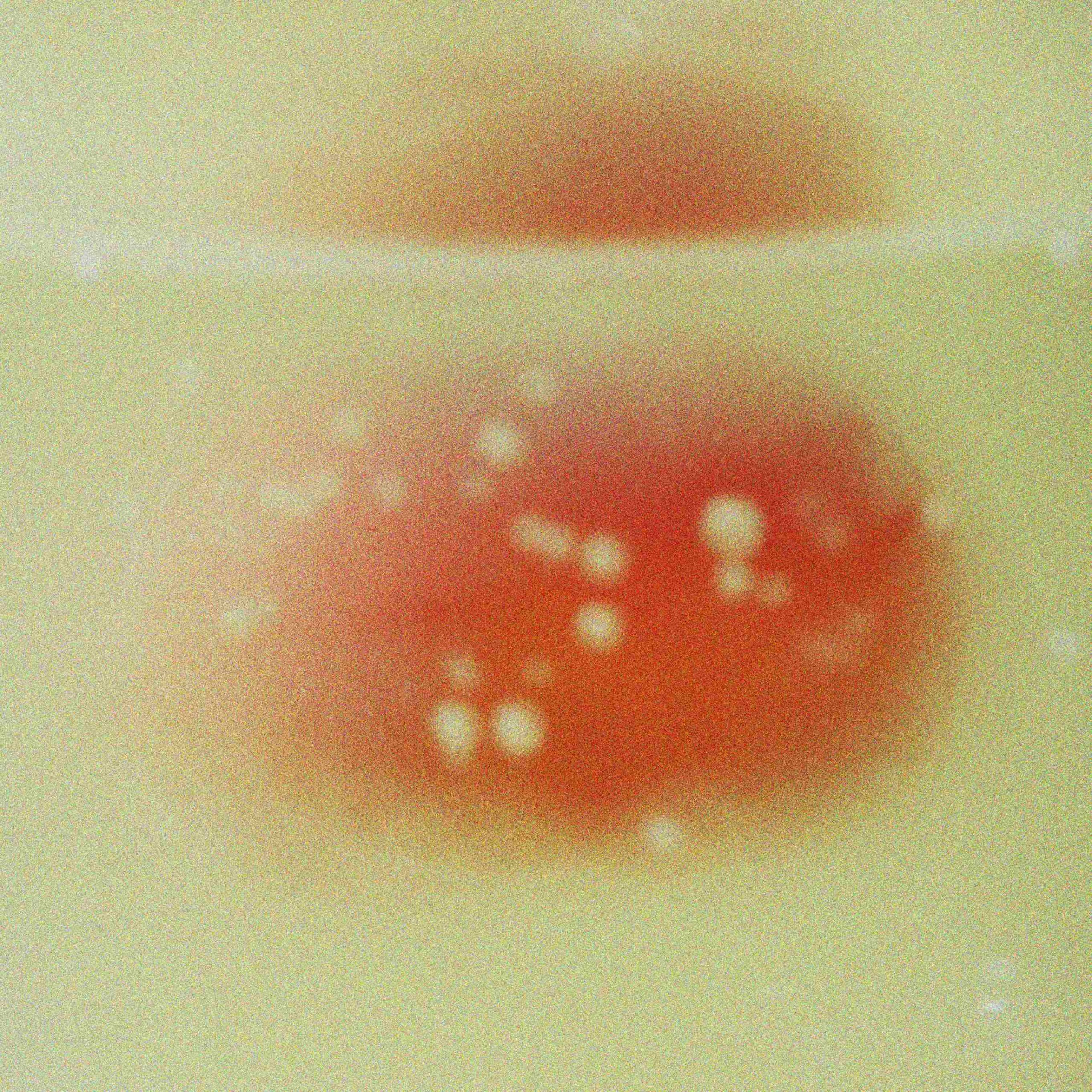 Blasenentzündung_Ruhr_Medizin